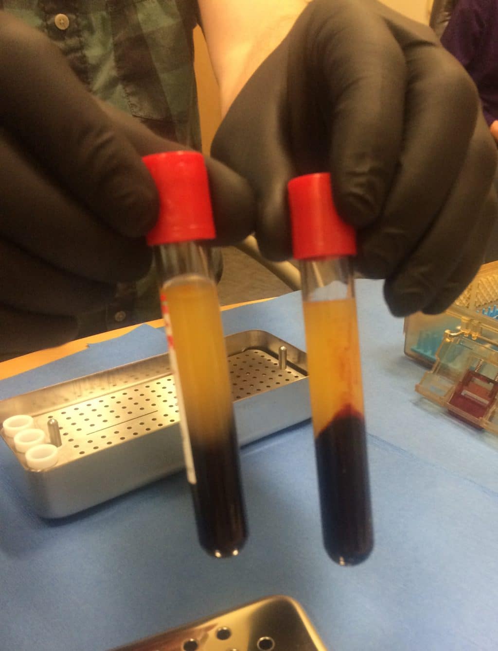 Blood sample with proteins separated