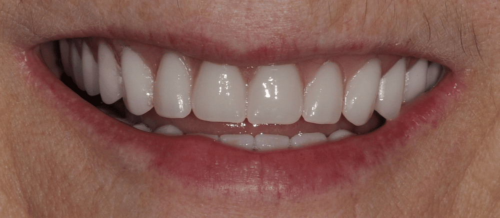 Implant-Supported Dentures