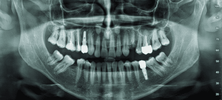 xray of teeth