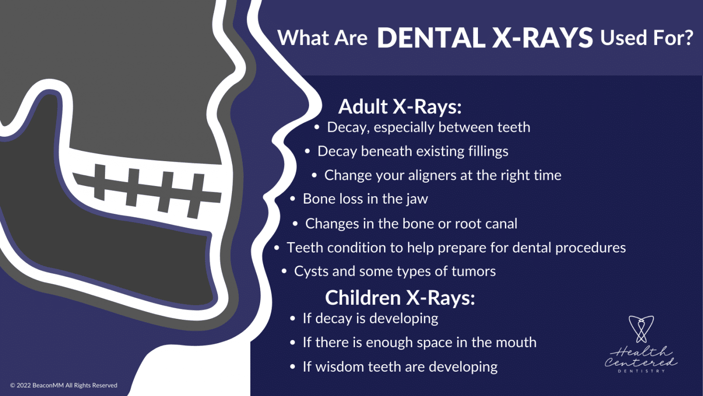 What are Dental X-Rays Used For? Infographic